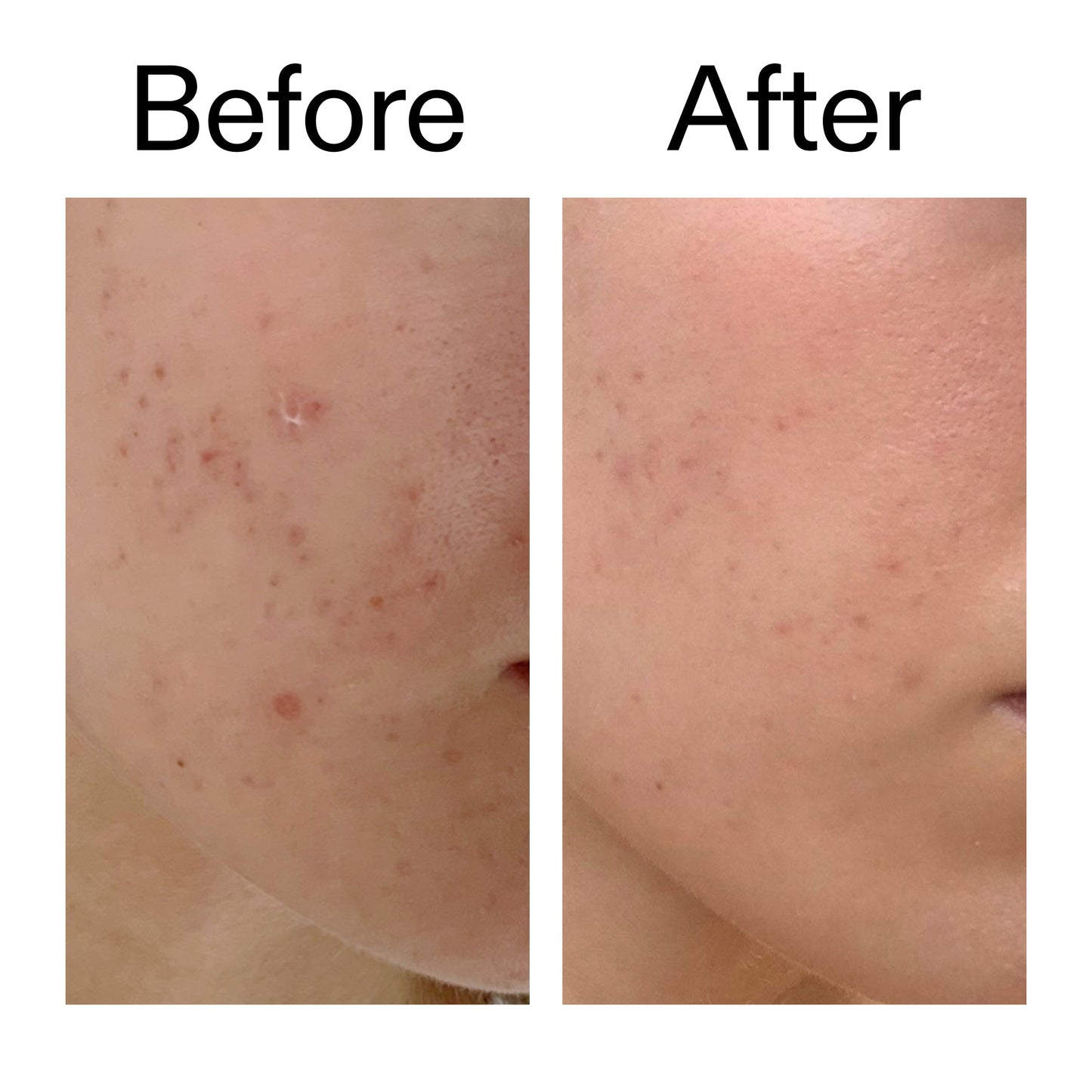 mandelic-acid-treatment-y9 Mandelic_Acid_Treatment_Before_After_2000x2000_4885ac6e-c5d7-4279-a72a-1417af7dce35.jpg