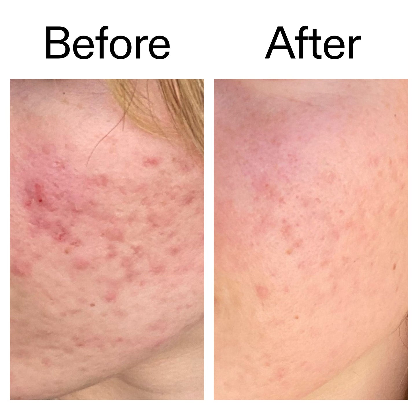 10-azelaic-acid-serum-for-redness-relief-k7 Azealic_Acid_Serum_B_A_Ppage_2000_x_2000.jpg