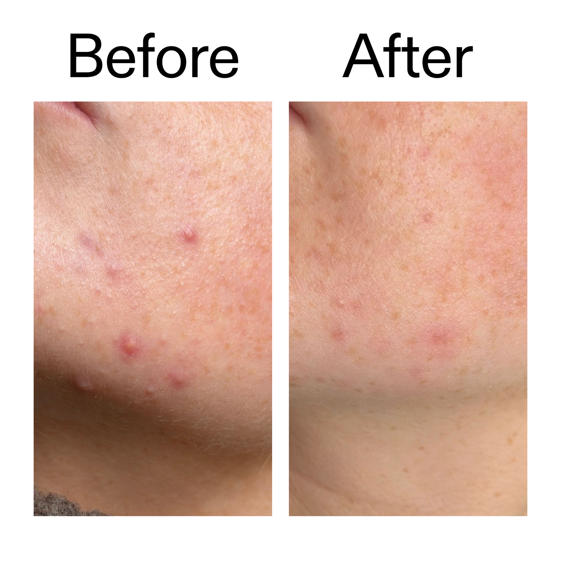 10-azelaic-acid-serum-for-redness-relief-k7 B_A_1_PPAGE.png