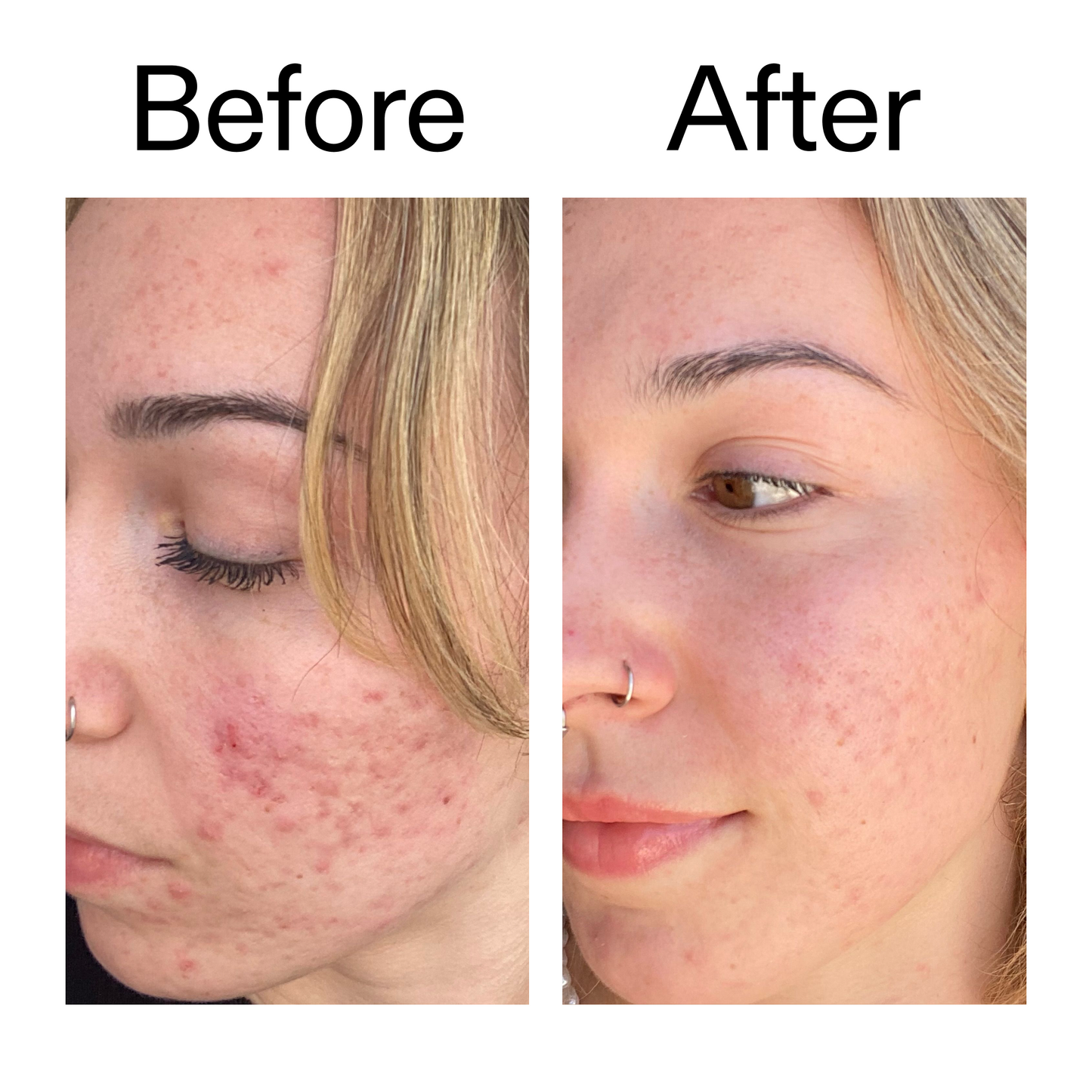 10-azelaic-acid-serum-for-redness-relief-k7 B_A_2_PPAGE.png