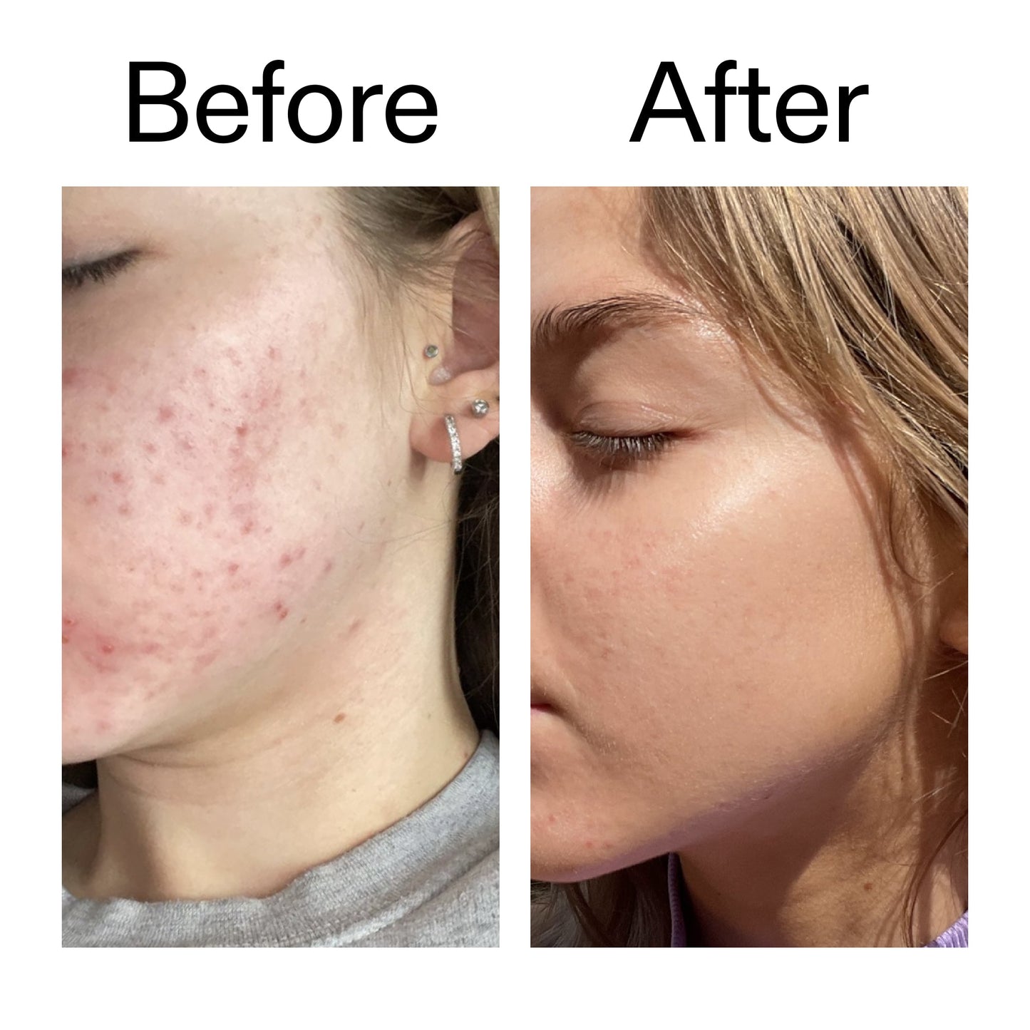 beta-hydroxy-acid-bha-serum-m7 Beta_Hydroxy_Acid_Serum_Before_After_2000x2000_96fda3e5-938d-49ef-bcf2-a0fa6ece4e2c.jpg