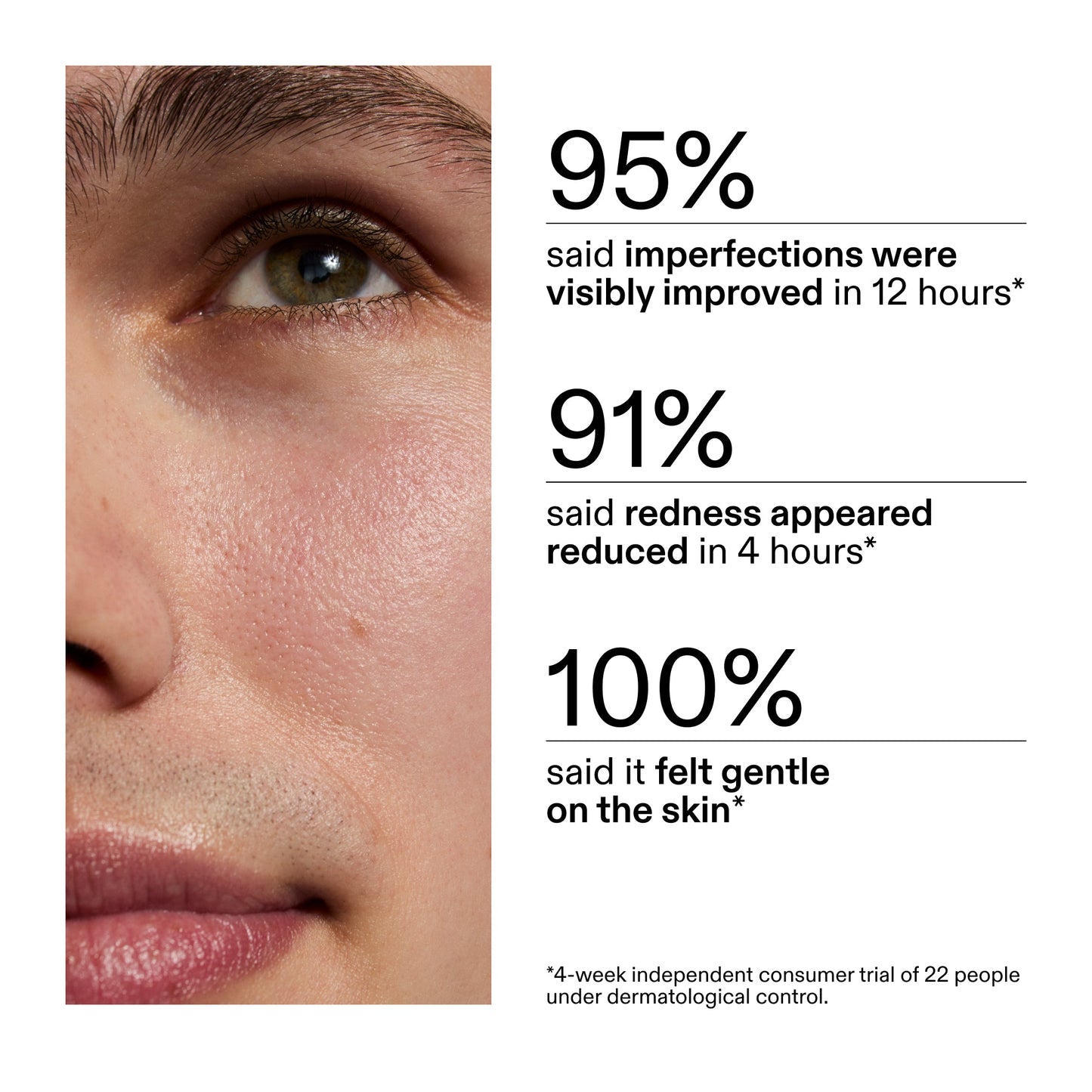 succinic-acid-acne-treatment-x3 CA_Succinic_Acid_Treatment_key_Claims_2000x2000_db91b0f1-7f29-4bfe-bb16-63a47f500960.jpg