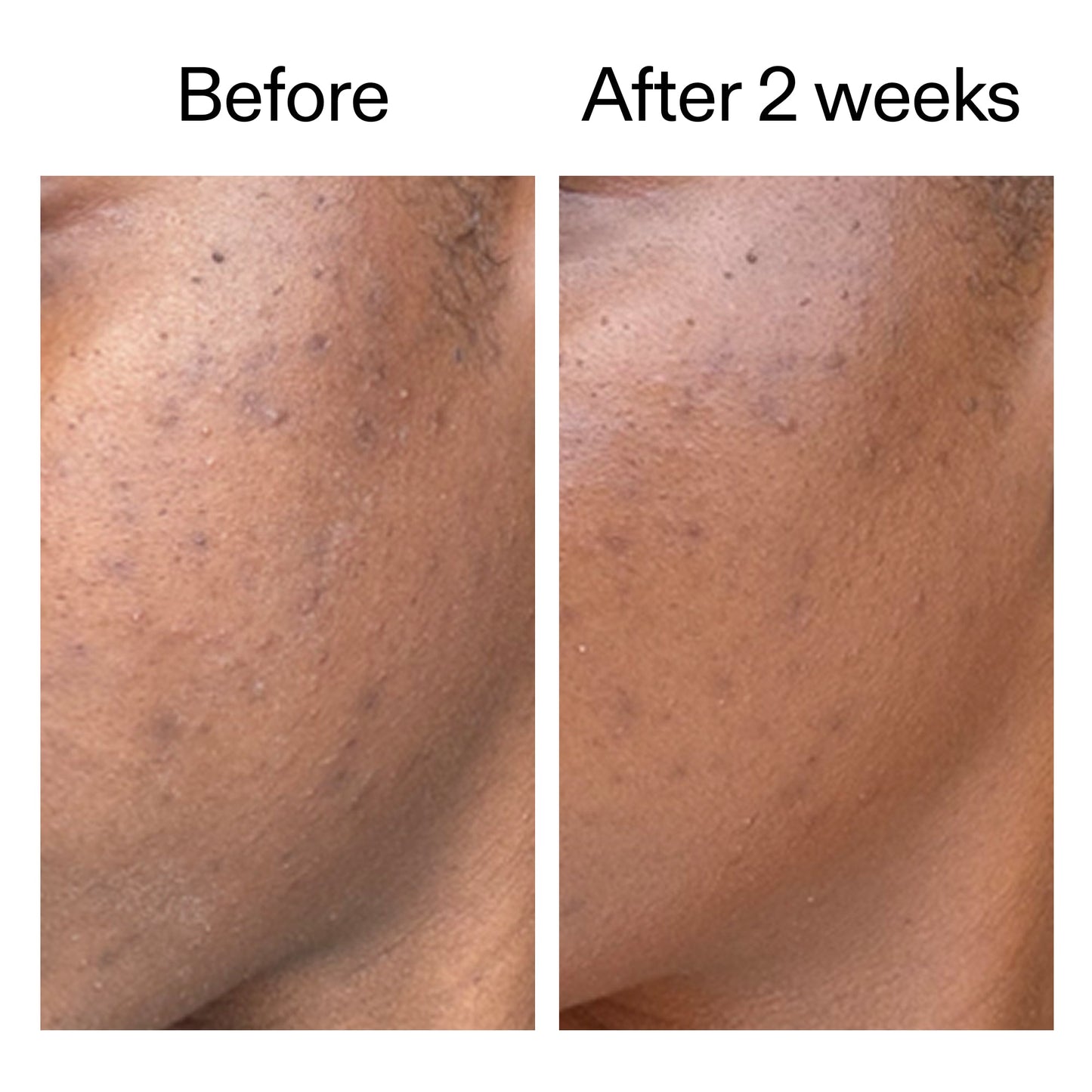 360-acne-clearing-duo-w7 DIOICB_A2000x2000.jpg
