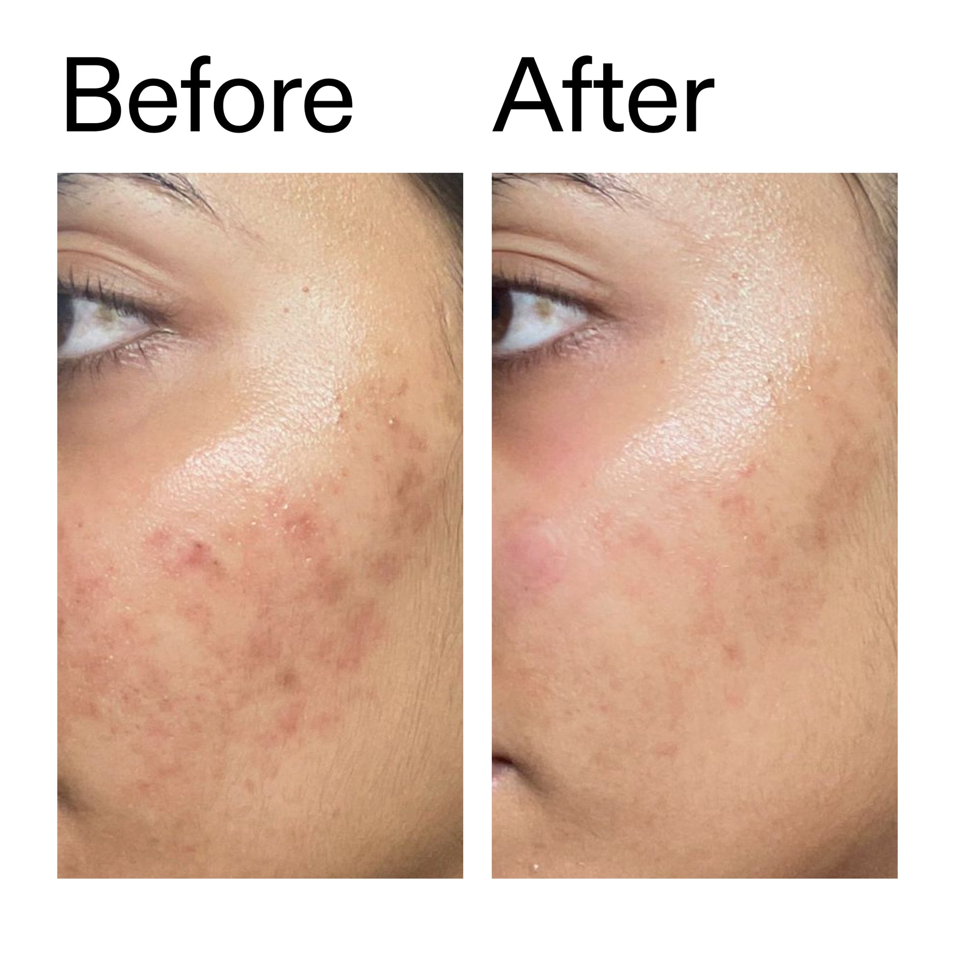 ectoin-hydro-barrier-serum-b6 Ectoin_Hydro-barrier_Serum__Before_After_2000x2000_34261920-d004-48d0-9c7b-8e1c15971bfd.jpg