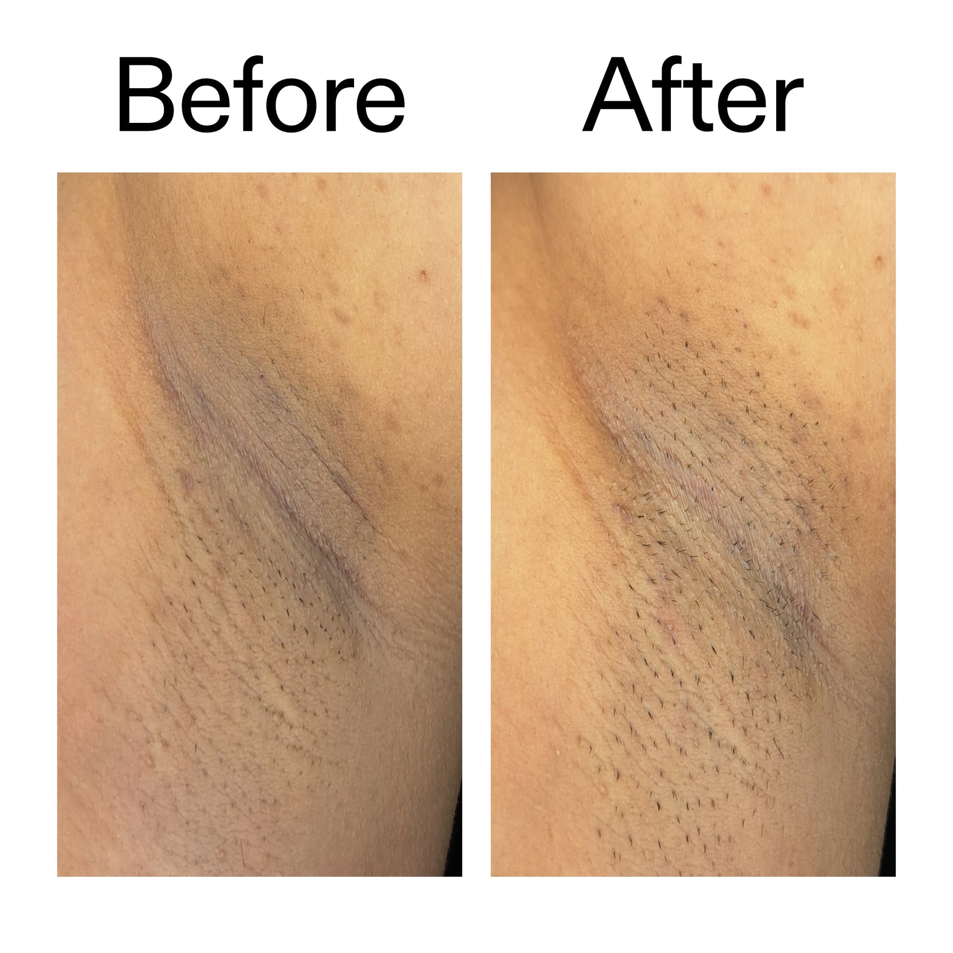 glycolic-acid-exfoliating-body-stick-duo-c9 Glycolic_Acid_Exfoliating_Body_Stick_Before_After_V3_2000x2000_ea919cd9-1439-4a46-82a0-76200eb5bb42.jpg