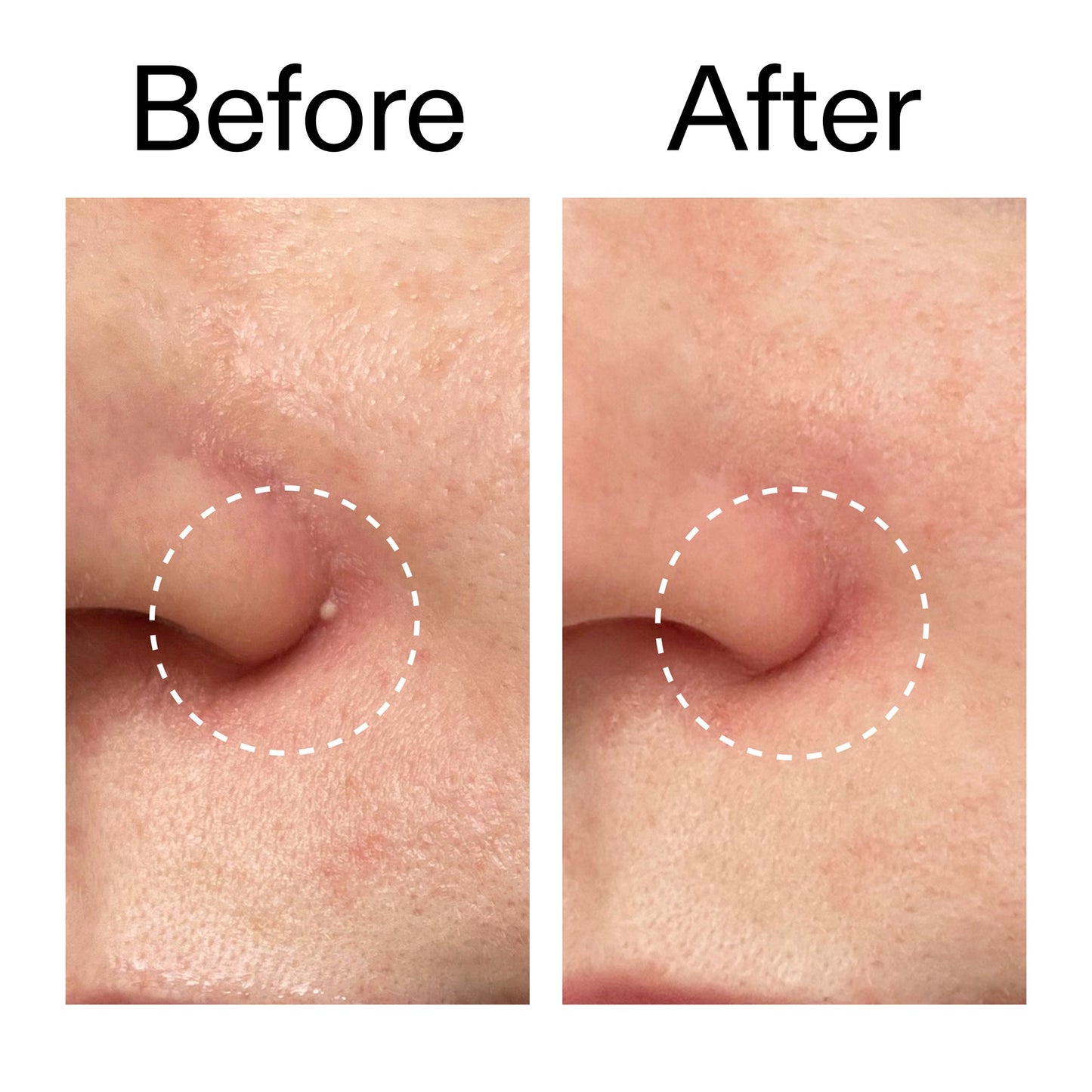 hydrocolloid-invisible-pimple-patches-pack-of-44-m7 Hydrocolloid_Invisible_Pimple_Patches_Before_After_2000x2000_b02aa37b-c78a-4682-91de-9135af5bb7df.jpg