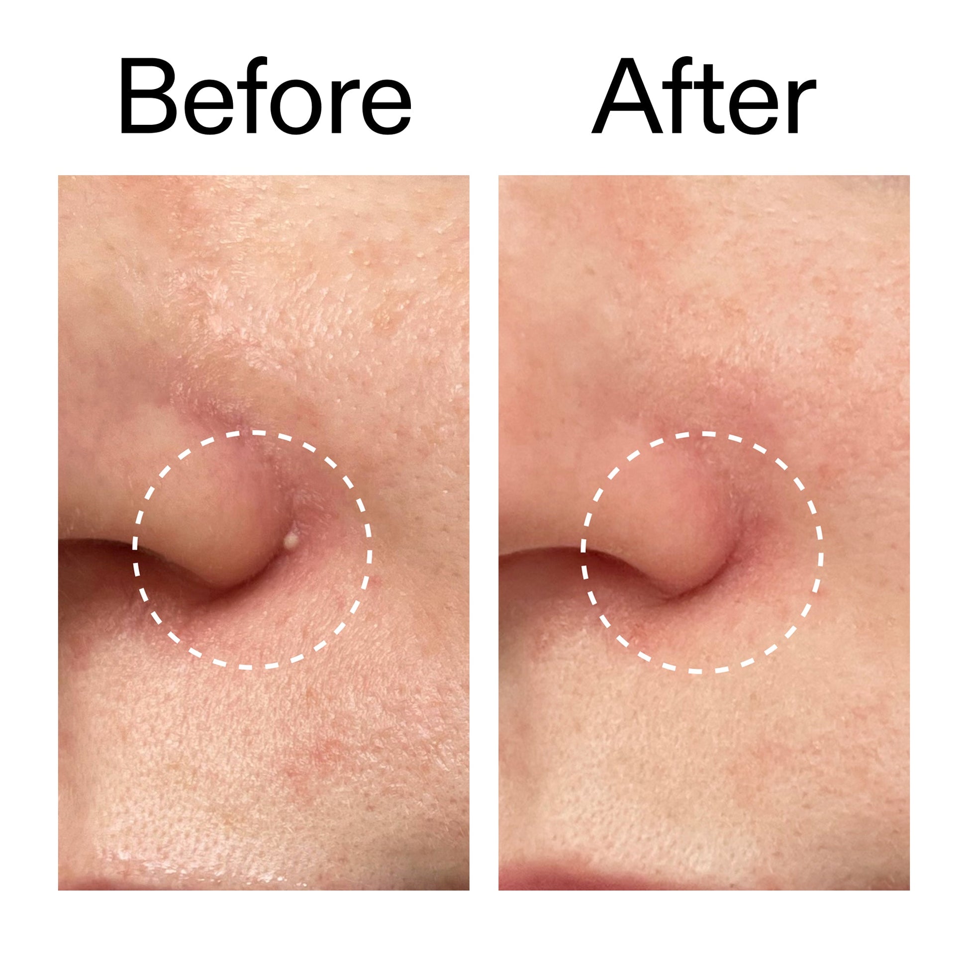 hydrocolloid-invisible-pimple-patches-pack-of-44-m7 Hydrocolloid_Invisible_Pimple_Patches_Before_After_2000x2000_b02aa37b-c78a-4682-91de-9135af5bb7df.jpg
