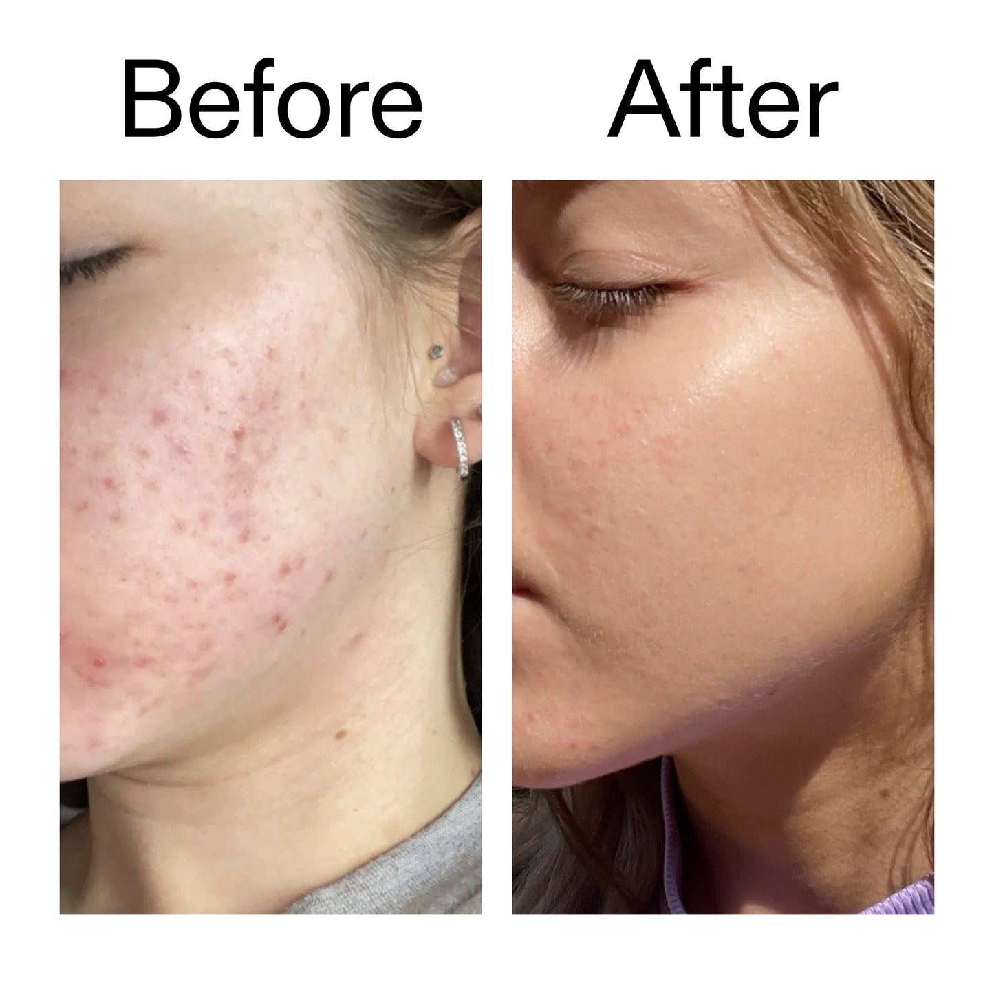 10-niacinamide-serum-duo-k2 Niacinamide_Serum_Before_After_2000x2000_bde32455-9e7d-448e-b053-bef41504f0a9.jpg