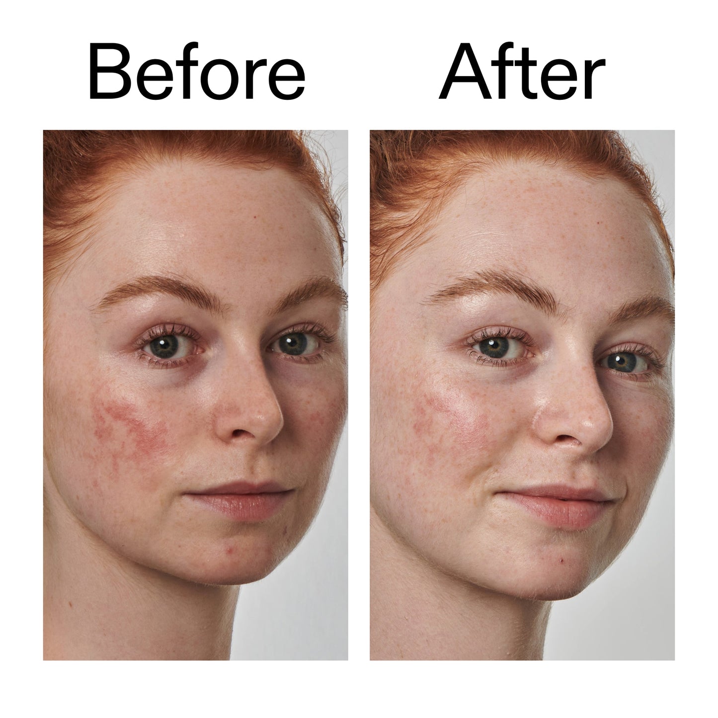 10-azelaic-acid-serum-for-redness-relief-k7 Redness_Relief_Serum_Before_After_2000x2000_3334dc9a-cce9-4e00-8aec-7ad89ca051f2.jpg