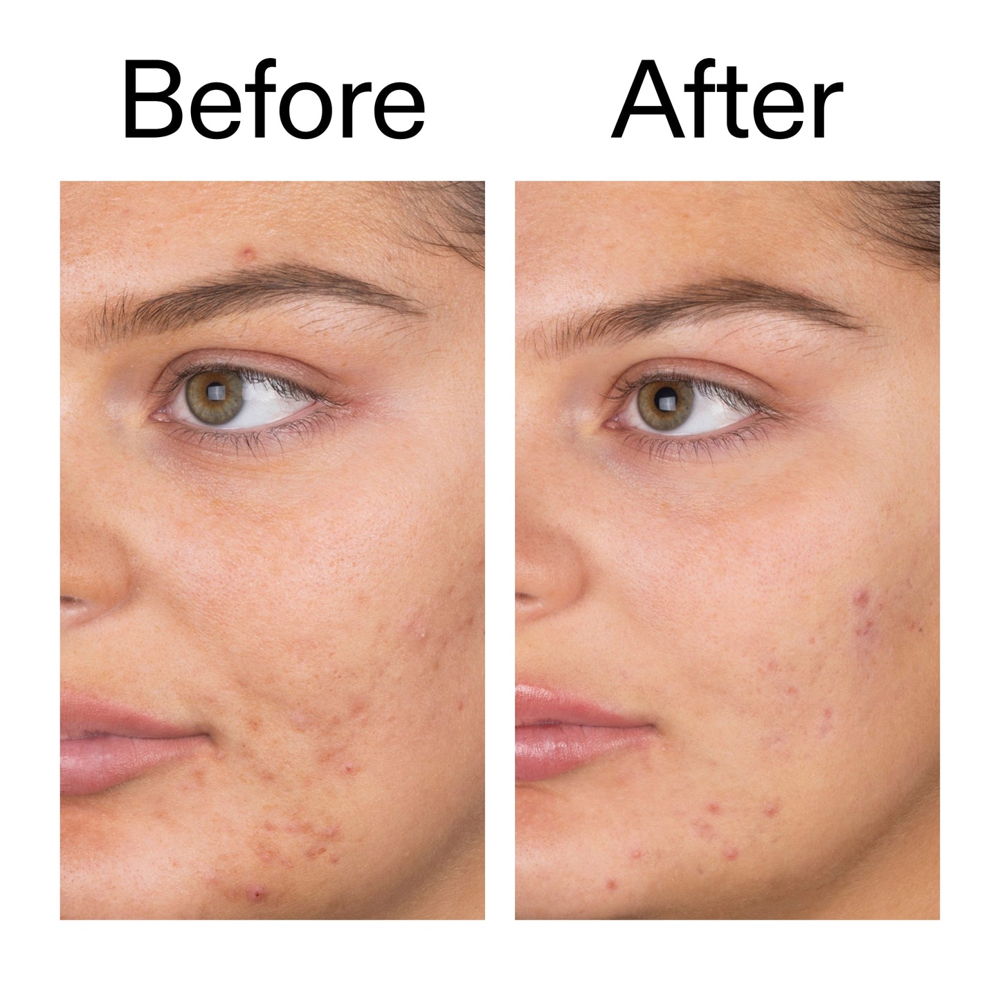 salicylic-acid-cleanser-150ml-x9 Salicylic_Acid_Cleanser_-_150ml_Before_After_2000x2000_e7230494-853f-4b07-82b1-27669104c995.jpg