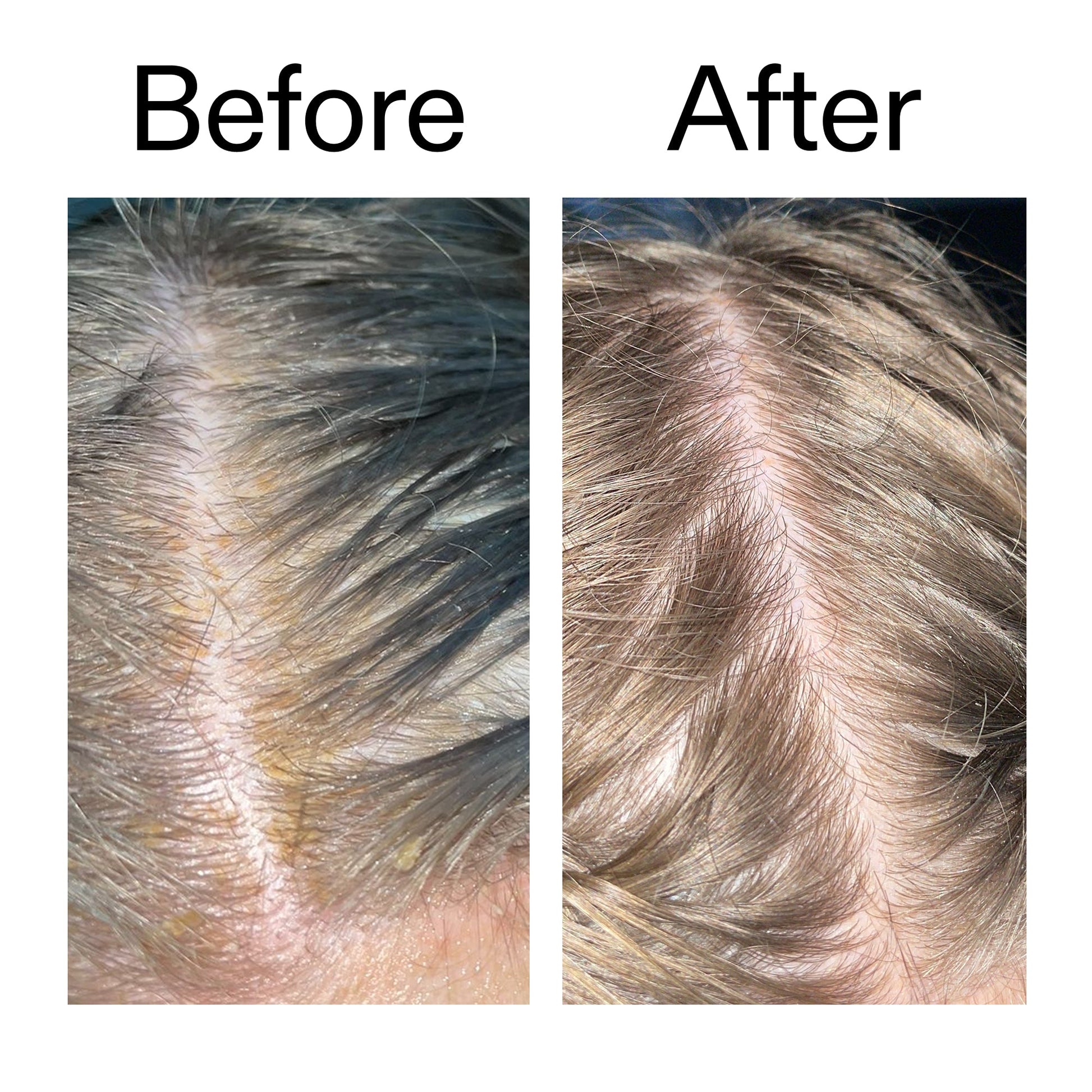 salicylic-acid-exfoliating-scalp-treatment-v8 Salicylic_Acid_Exfoliating_Scalp_Treatment_Before_After_2000x2000_e572a30f-057c-4a48-823b-1c09dc97f8d0.jpg