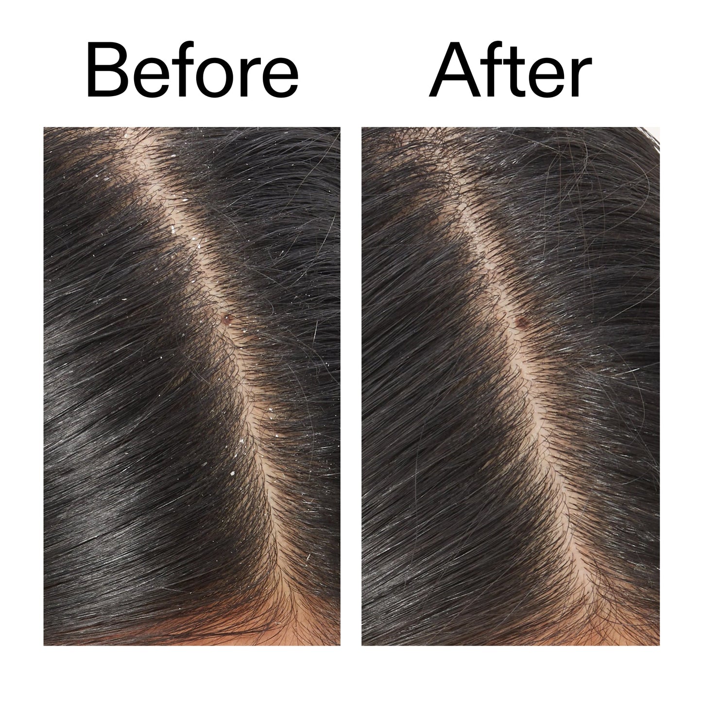 salicylic-acid-exfoliating-scalp-treatment-v8 Salicylic_Acid_Exfoliating_Scalp_Treatment_Before_After_V2_2000x2000_02bd61ad-42bf-490b-b3e3-7e04b2e8a673.jpg