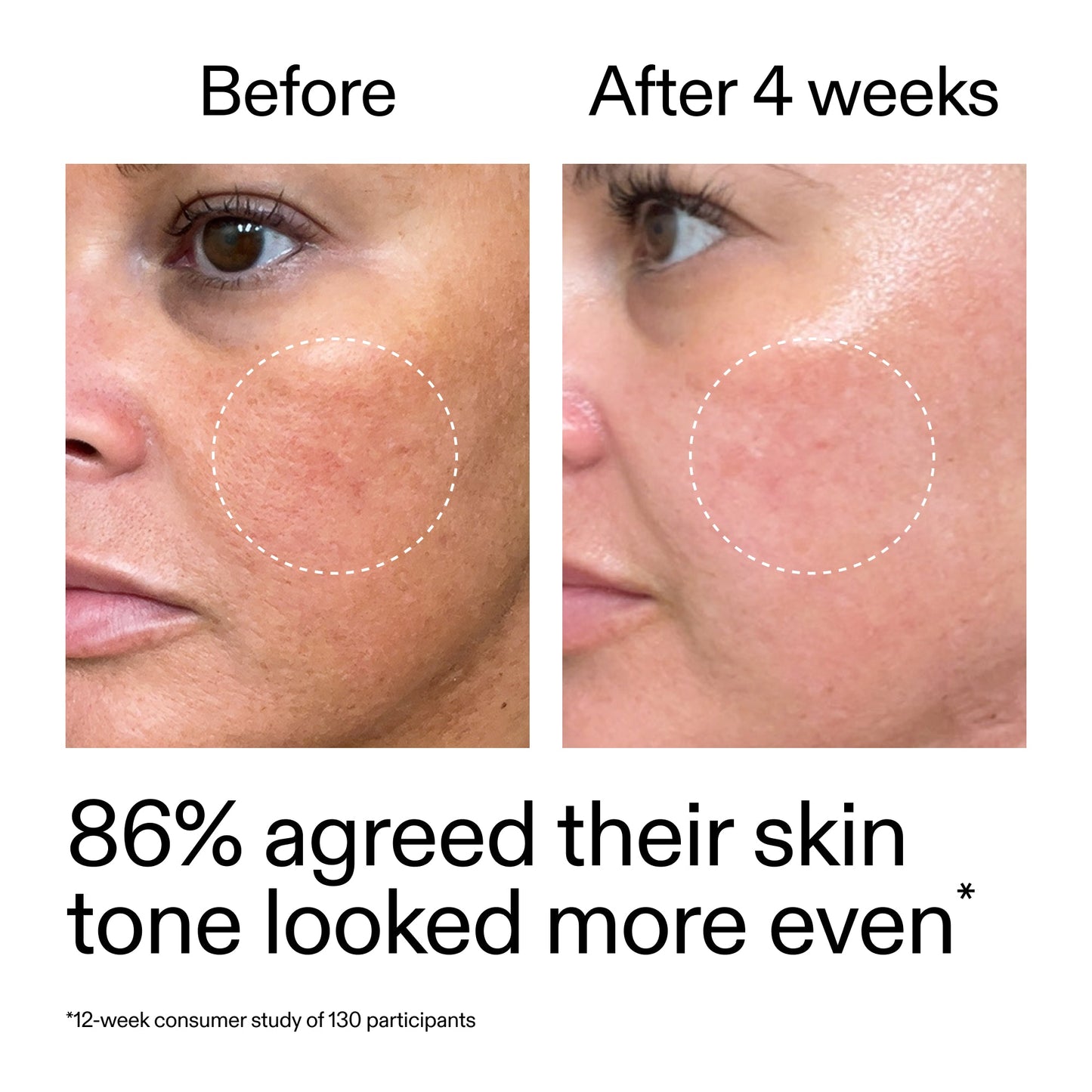 starter-retinol-serum-y5 StarterRetinol_BeforeAfter_Claim2_2000x2000_f5c9ecc0-8d76-429d-bef5-c3a61bcf5c09.jpg