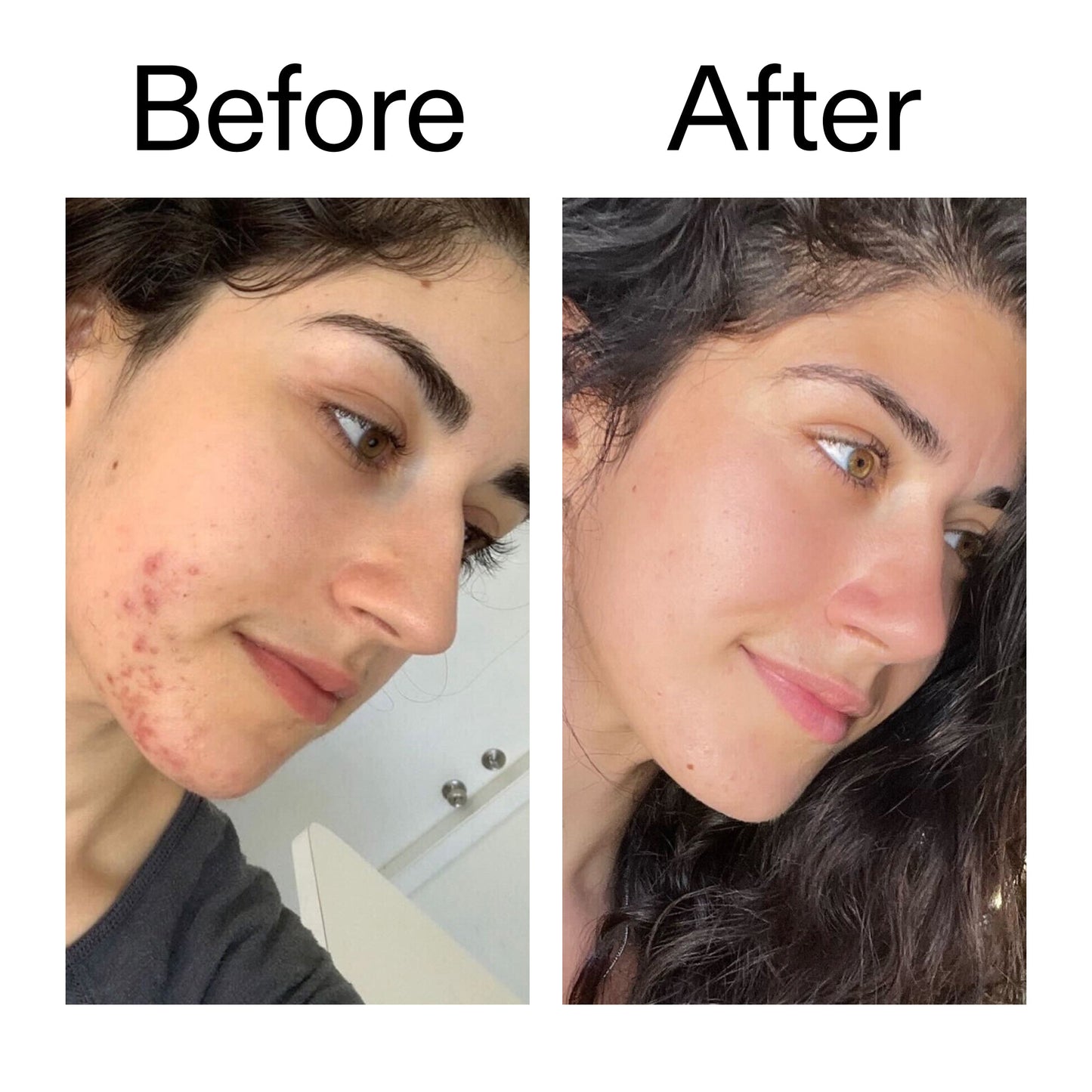 succinic-acid-acne-treatment-x3 Succinic_Acid_Treatment_Before_After_2000x2000_6a5f0054-2f58-4433-9314-0dc72c9bdd3b.jpg
