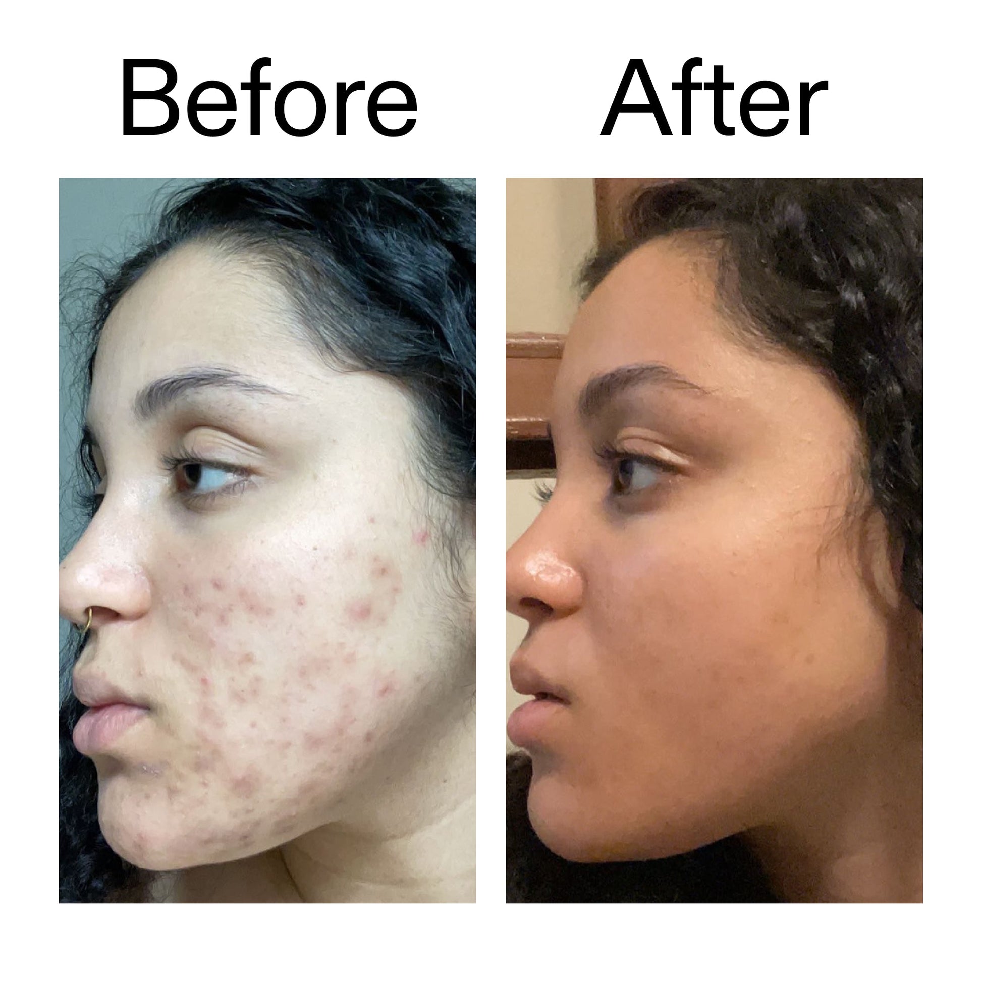 tranexamic-acid-serum-j1 Tranexamic_Acid_Serum_Before_After_2000x2000_98ebc8be-77b0-4843-8a22-90790ebe918b.jpg